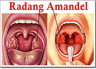 Healing Tonsils Without Surgery